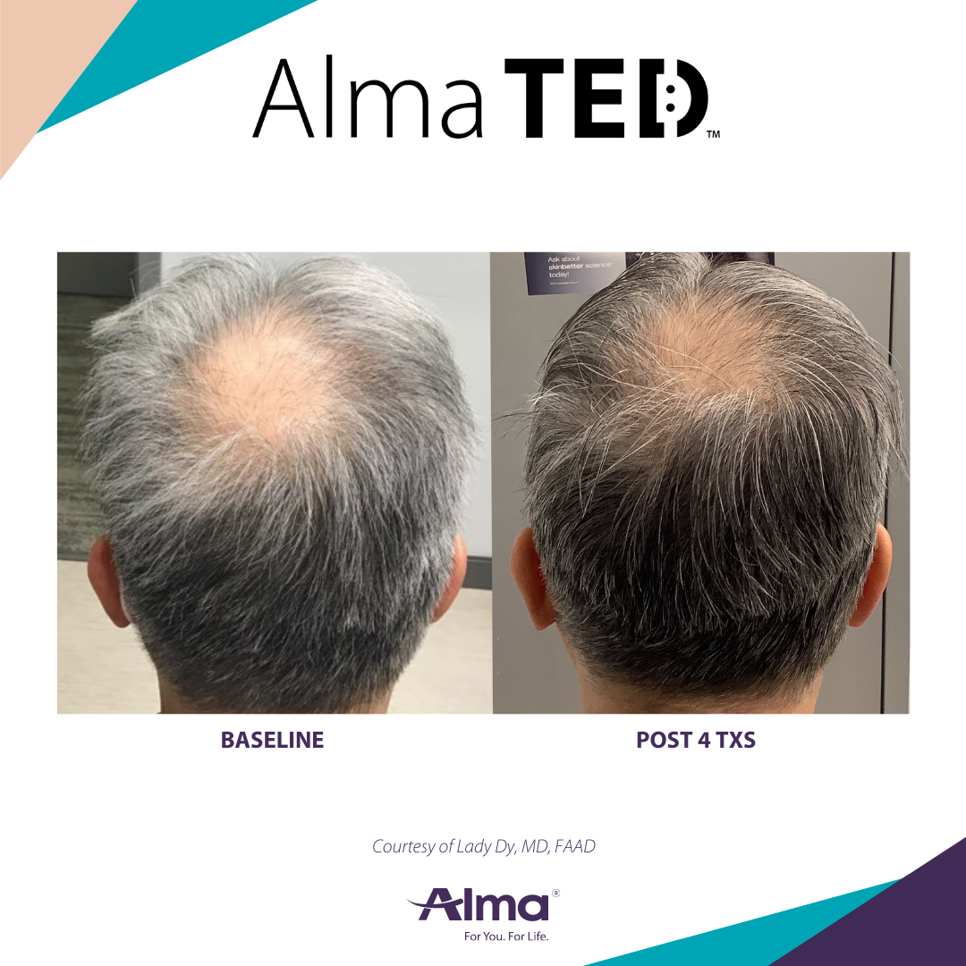 Alma Ted Hair Restoration Oklahoma