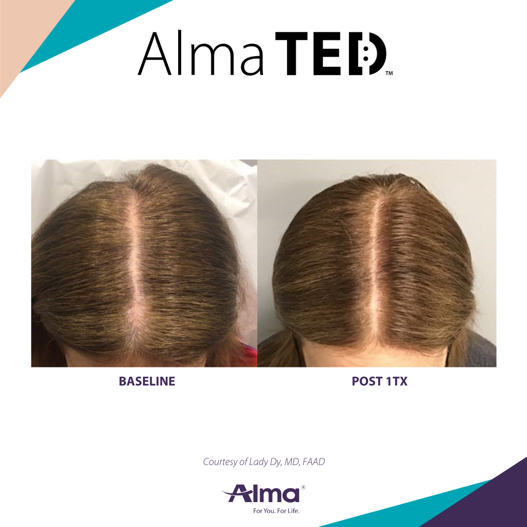 Alma Ted Tulsa Hair Restoration
