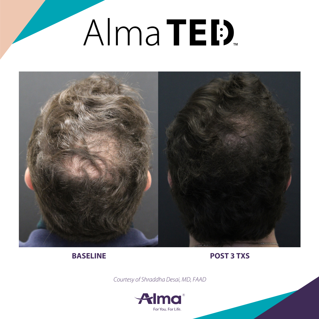 Alma Ted Tulsa Hair Restoration