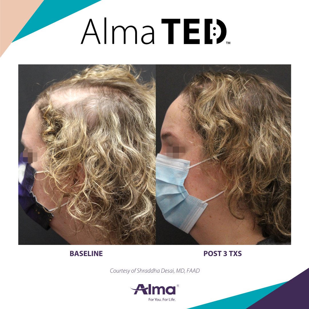Alma Ted Hair Restoration