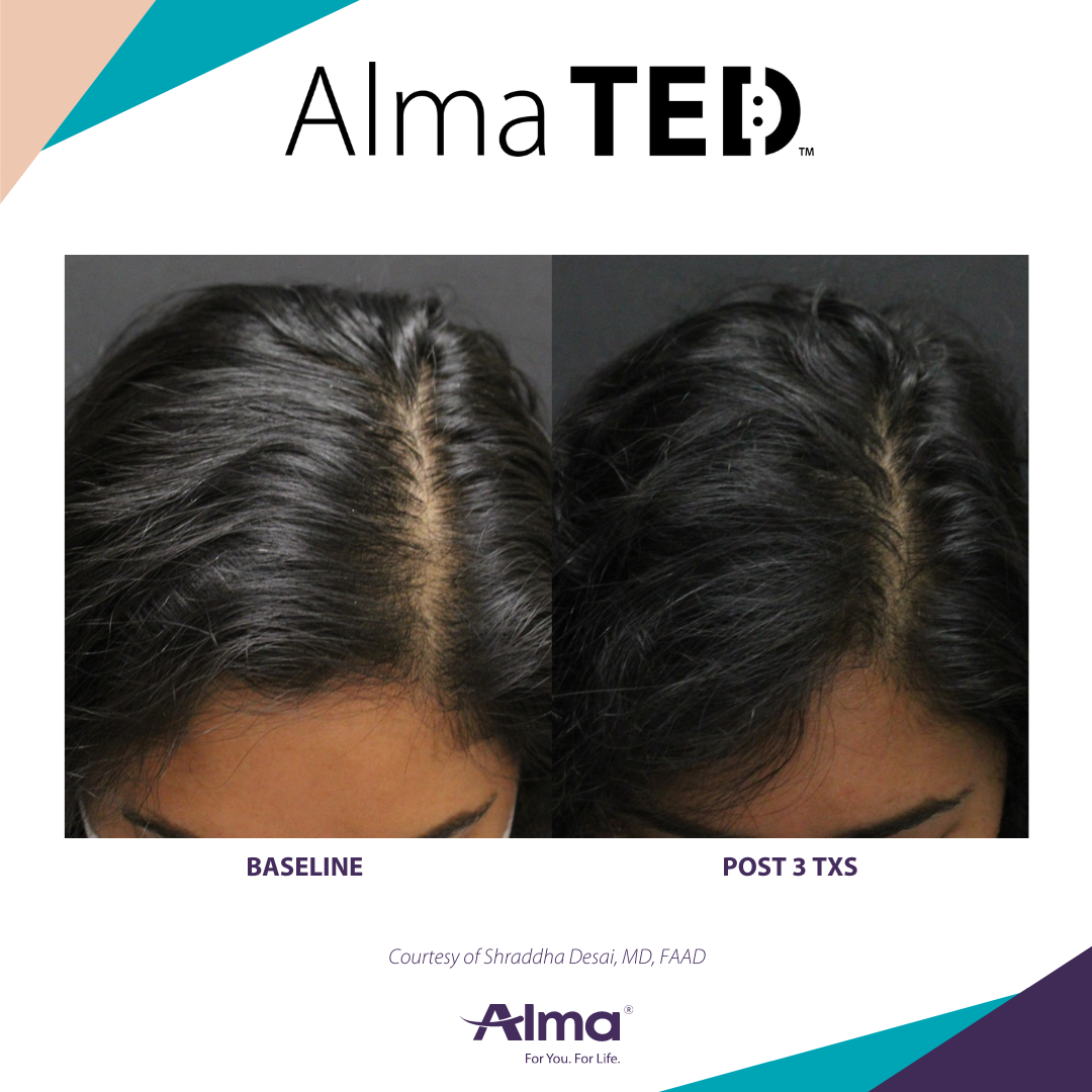 Alma Ted Oklahoma Hair Restoration